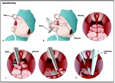 Tonsils Operation