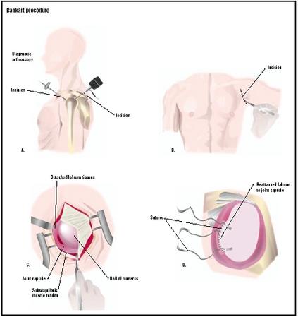 A Bankart procedure may be performed laparoscopically (A), or through an open incision in the shoulder (B). In the open procedure, the surgeon exposes the joint capsule and labrum, a rim of soft tissue that surrounds the cavity, which has become detached (C). Sutures reattach the labrum to the joint capsule (D). (Illustration by GGS Inc.)