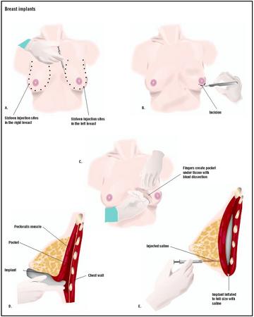 During a breast implant procedure, a local injection of anesthetic is administered at many points around the breast (A). An incision is made under the areola (B). The surgeon uses his fingers to create a pocket for the implant (C). The implant is placed under the pectoralis muscle of the chest (D), and is inflated to full size with saline injections (E). (Illustration by GGS Inc.)