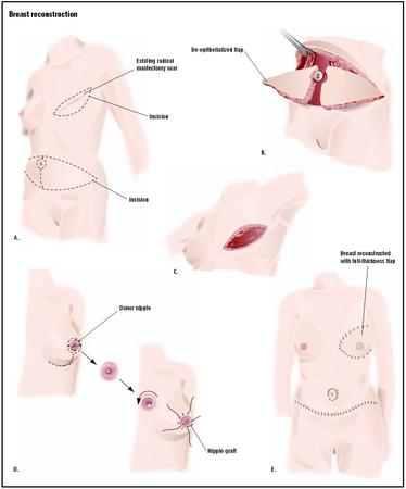 Breast reconstruction is often performed after a mastectomy. In an autologous procedure, a section of tissue from the patient's abdomen (B) is used to create a natural-looking new breast. In a separate procedure, a layer of the patient's existing nipple can be grafted onto the new breast (D). (Illustration by GGS Inc.)