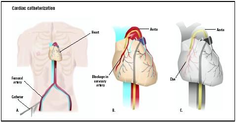 During cardiac catherization, a catheter is fed into the femoral artery of the upper leg (A). The catheter is fed up to coronary arteries to an area of blockage (B). A dye is released, allowing visualization of the blockage (C). (Illustration by GGS Inc.)