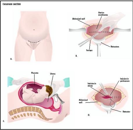 To remove a baby by cesarean section, an incision is made into the abdomen, usually just above the pubic hairline (A). The uterus is located and divided (B), allowing for delivery of the baby (C). After all the contents of the uterus are removed, the uterus is repaired, and the rest of the layers of the abdominal wall are closed (D). (Illustration by GGS Inc.)