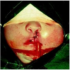 Infant in recovery from a cleft lip repair. (Biophoto Associates/Science Source. Reproduced by permission.)