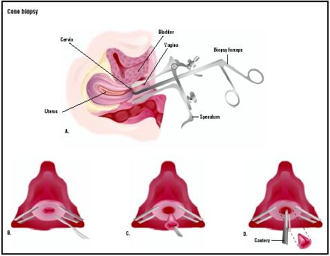 In a cone biopsy, the patient lies on her back, and a speculum is inserted into the vagina (A). The cervix is visualized, and a cone-shaped piece of the cervix is removed (B and C). A cauterizing tool is used to stop any bleeding (D). (Illustration by GGS Inc.)