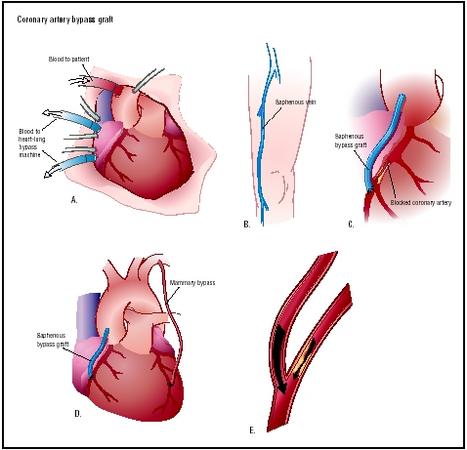 coronary artery surgery