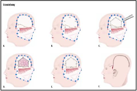 In a craniotomy, the skin over a part of the skull is cut and pulled back (A). Small holes are drilled into the skull (B), and a special saw is used to cut the bone between the holes (C). The bone is removed, and a tumor or other defect is visualized and repaired (D). The bone is replaced (E), and the skin closed (F). (Illustration by GGS Inc.)