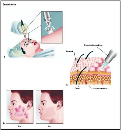 A doctor performs dermabrasion with a high-speed rotary wheel (A). The tool takes off the top layers of the skin (B) to improve the appearance of wrinkles or scars (C). (Illustration by GGS Inc.)