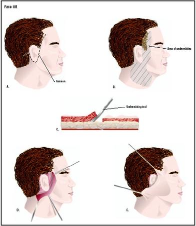 For a face lift, an incision is made around the ear at the base of the hairline (A). The skin is removed from underlying tissues in a procedure called undermining (B and C). The skin is pulled up to tighten it (D). The skin is stitched into place and excess is removed (E). (Illustration by GGS Inc.)