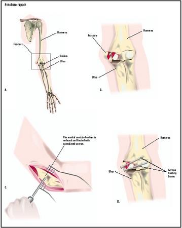 In this patient, a fall has resulted in fractures in the bones of the elbow (B). To repair the fracture, an incision is made in the elbow area (C), and the bones are fixed with screws to aid proper healing (D). (Illustration by GGS Inc.)