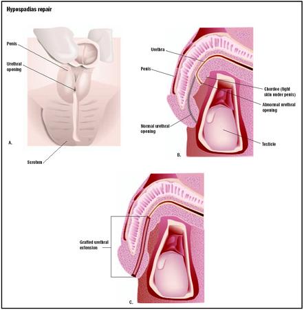 In hypospadias, the urethral opening is at the base of the penis, instead of the tip (A). Tissue grafts are used to create an extension for the urethra (C) and alleviate the tight skin, or chordee, on the underside of the penis. (Illustration by GGS Inc.)