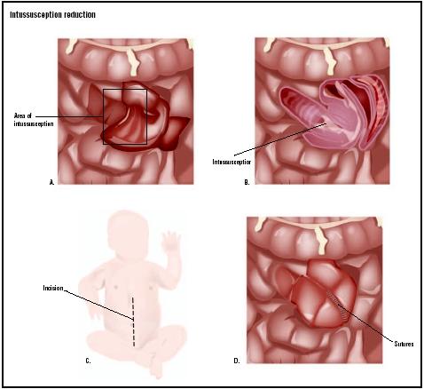 Intussusception of the bowel results in the bowel telescoping onto itself (A and B). An incision is made in the baby's abdomen to expose the bowel (C). If the surgeon cannot manipulate the bowel into a normal shape manually, the area of intussusception wil be removed and remaining bowel sutured together (D). (Illustration by GGS Inc.)