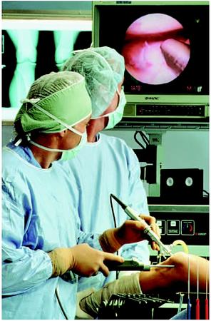 Surgeons watching a monitor showing the inside of a patient's knee during arthroscopic knee surgery. (Custom Medical Stock Photo. Reproduced by permission.)