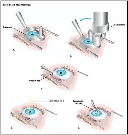 In LASIK surgery, the eye is held open with a speculum, and a suction ring is attached to the eyeball (A). A microkeratome is used to shave the protective flap off the top of the eye (B), which is then pulled back (C). A computer-controlled laser is used to reshape the cornea (D), and the protective flap is replaced (E). (Illustration by GGS Inc.)