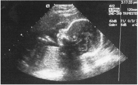 Fetal ultrasound during the second to third trimester. (Brigham Narins. Reproduced by permission.)