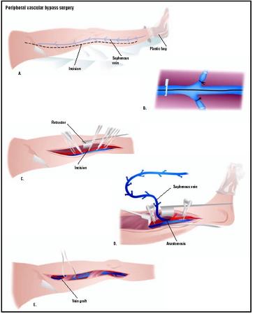 In this femoropopliteal bypass, a portion of the saphenous vein can be removed and used to bypass a portion of a diseased artery. To accomplish this, an incision is made down the inside of the leg (A). The saphenous vein is tied off from its tributaries and removed (B). An incision is made in the recipient artery (C), and the vein is stitched to it at the top and bottom of the leg (D). (Illustration by GGS Inc.)