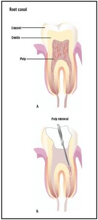 During a root canal, the diseased pulp of a tooth (A), is removed (B). The remaining empty tooth is filled and sealed with a filling or crown. (Illustration by GGS Inc.)