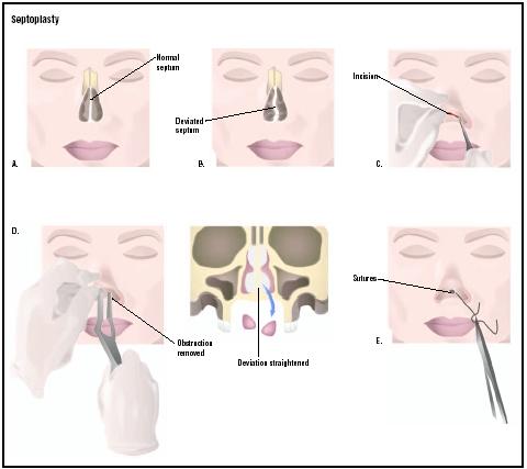 Septoplasty is used to correct a deviated septum (B). First an incision is made to expose the nasal septum (C). Pieces of septum that are obstructing air flow are removed (D), and the incision is then closed (E). (Illustration by GGS Inc.)